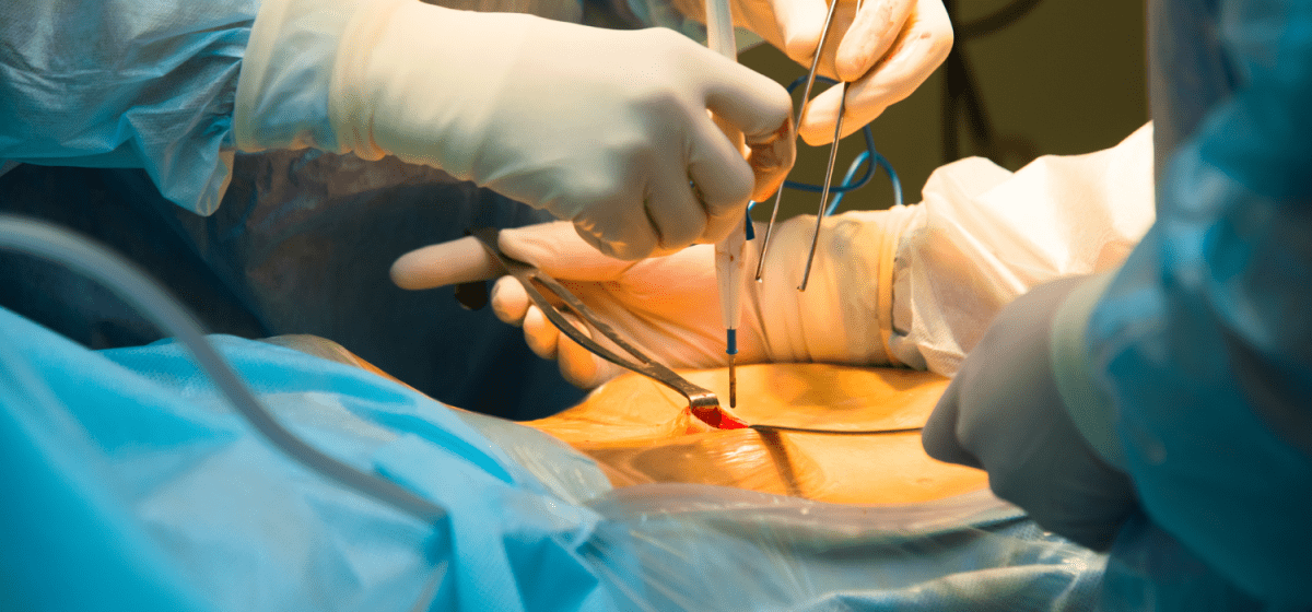 Laparoscopia digestiva napoli