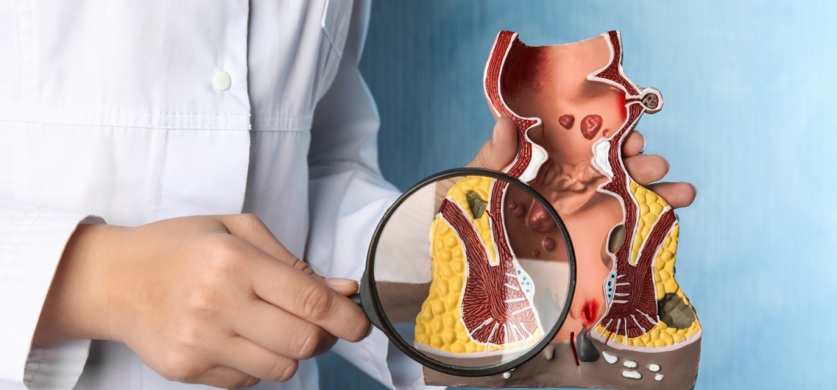 colonscopia indolore Napoli